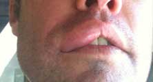 Cerritos Bee Removal Guy Anthony picture of swelling after being stung 
    on the lip.